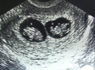 Last ultrasound scan at 15 weeks